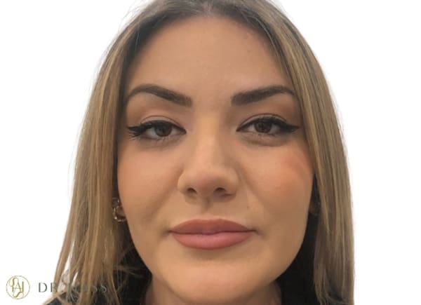 Anti Wrinkle Injections