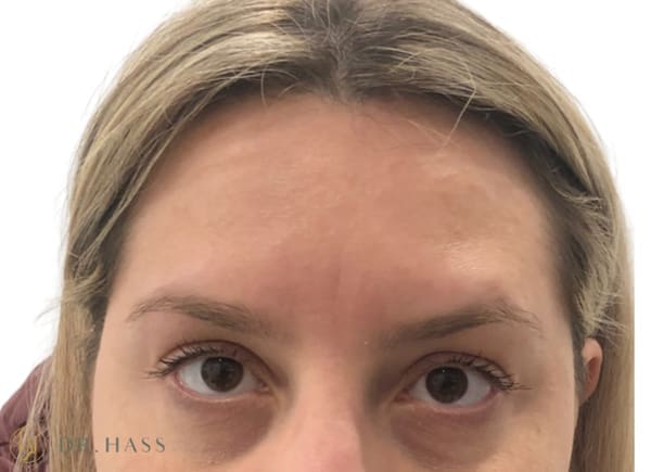 Anti Wrinkle Injections