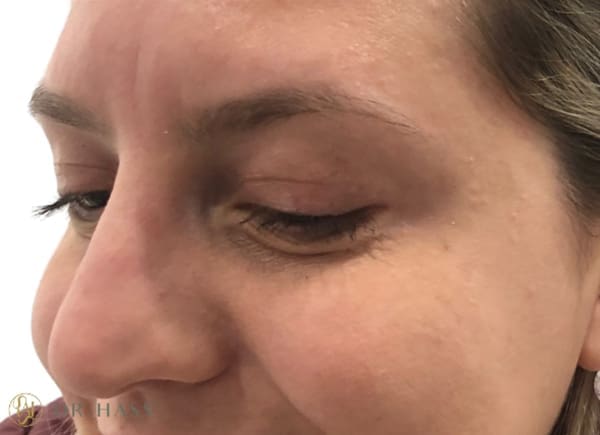 Anti Wrinkle Injections