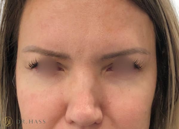 Anti Wrinkle Injections
