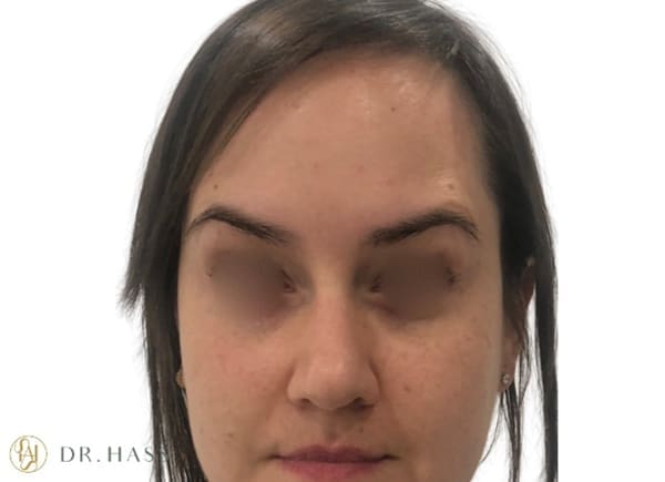 Anti Wrinkle Injections