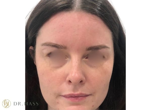 Anti Wrinkle Injections