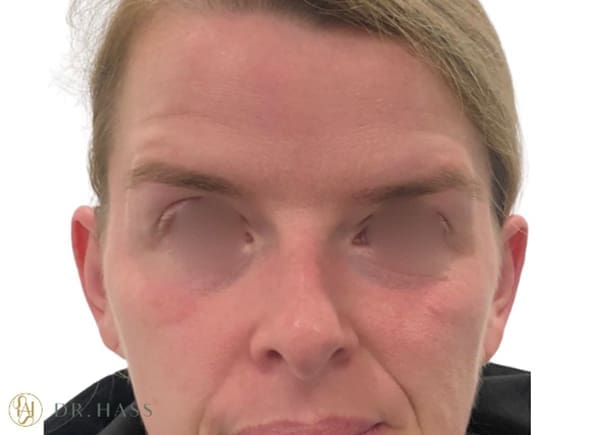 Anti Wrinkle Injections