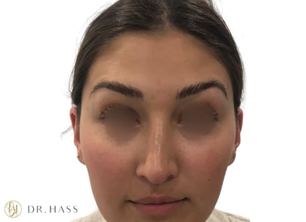 Anti Wrinkle Injections