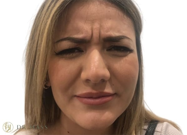 Anti Wrinkle Injections