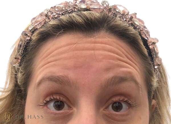 Anti Wrinkle Injections