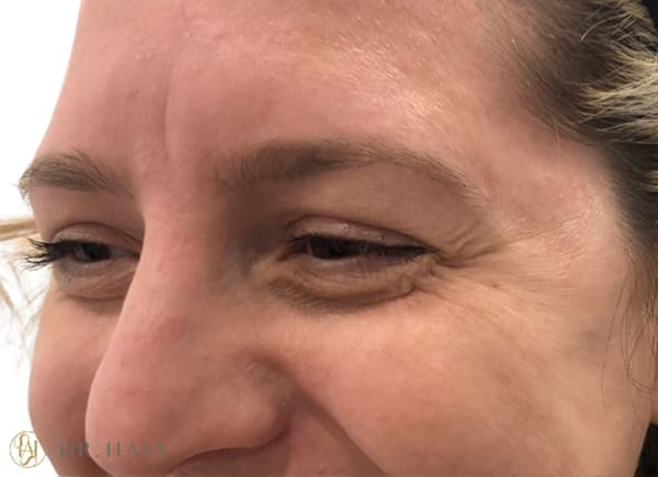 Anti Wrinkle Injections