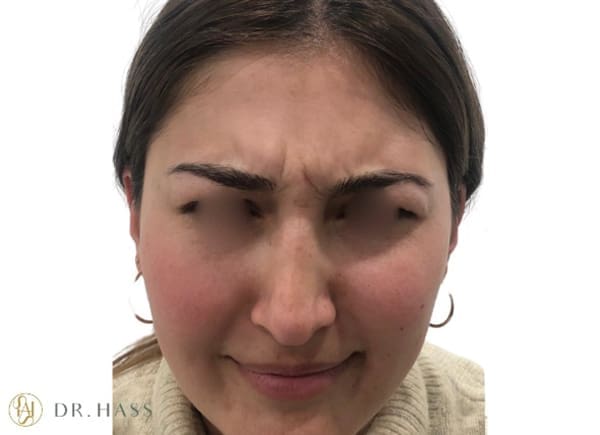 Anti Wrinkle Injections