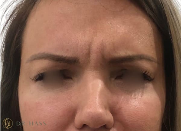 Anti Wrinkle Injections