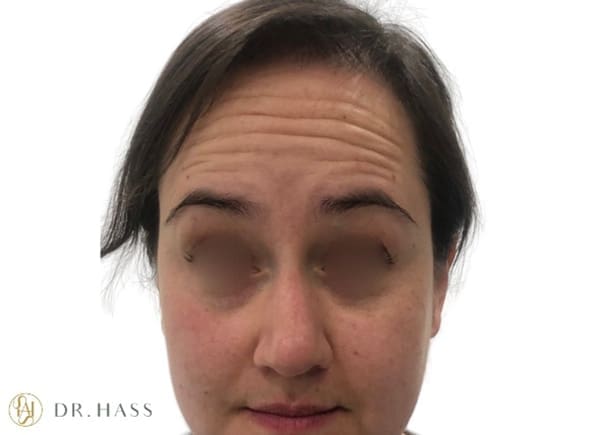 Anti Wrinkle Injections