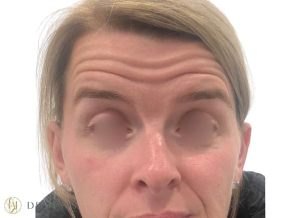 Anti Wrinkle Injections