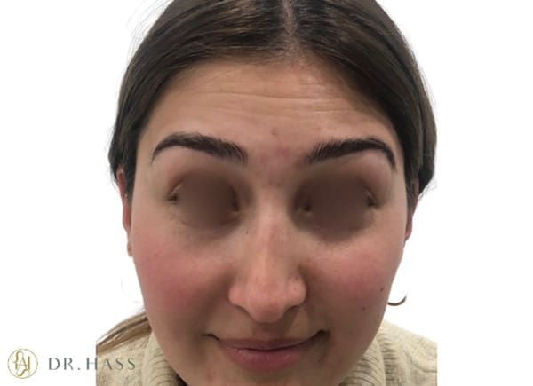 Anti Wrinkle Injections