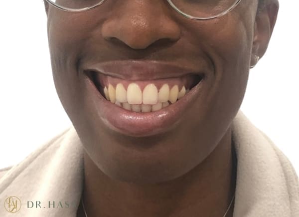 Gummy Smile