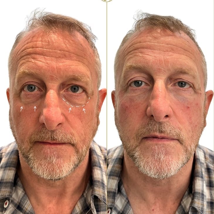 Tear Trough Filler Result