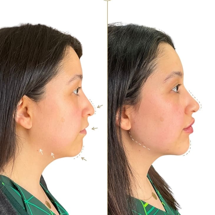 Profile balancing result