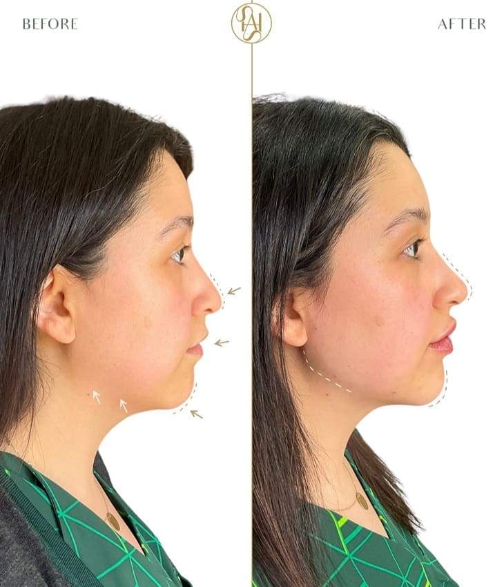 Profile balancing result