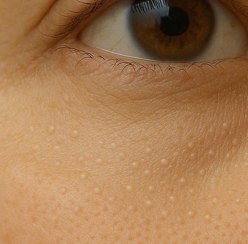 milia-close-up