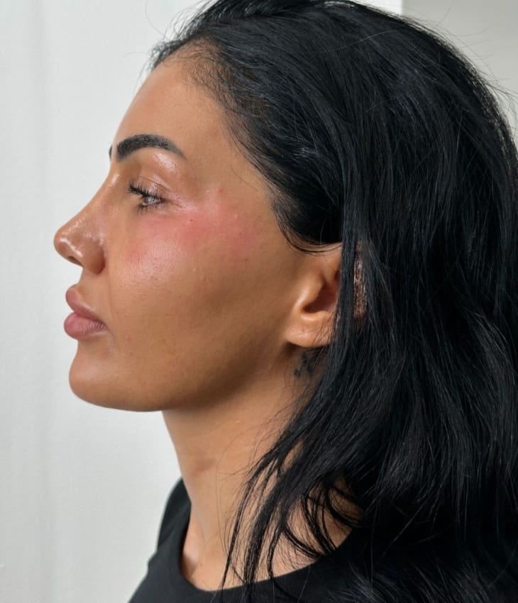 Cheek Filler Treatment Stage Image - Dr Hass Clinic