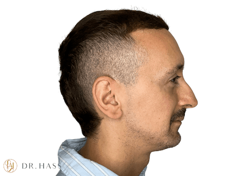 Dr-Hass-Chin-Filler