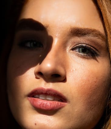 Rosacea