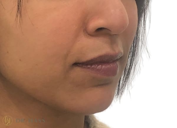 Smile Lines