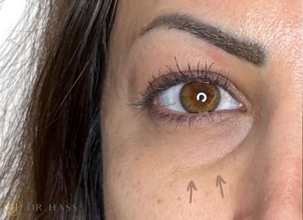Tear Trough