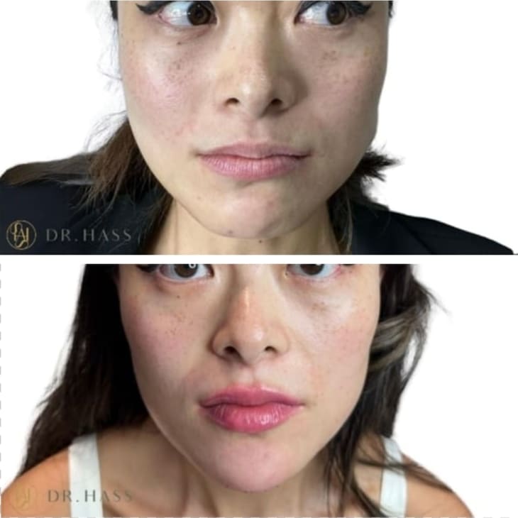 Masseter Reduction Before and After