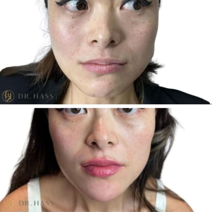 Masseter Reduction Before and After - Dr Hass Clinic