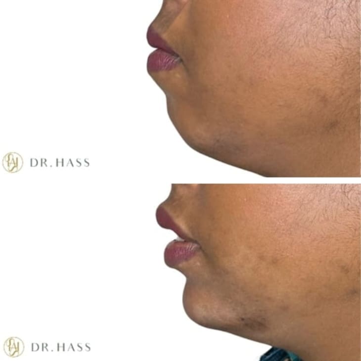 Chin Filler Before and After | Dr Hass Clinic