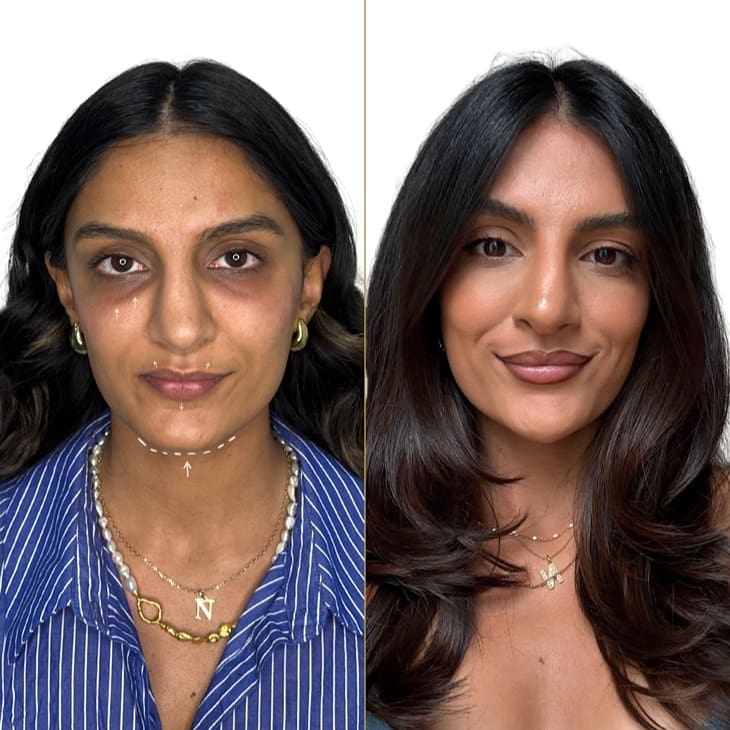 endolift-before-and-after-full-face-rejuvenation