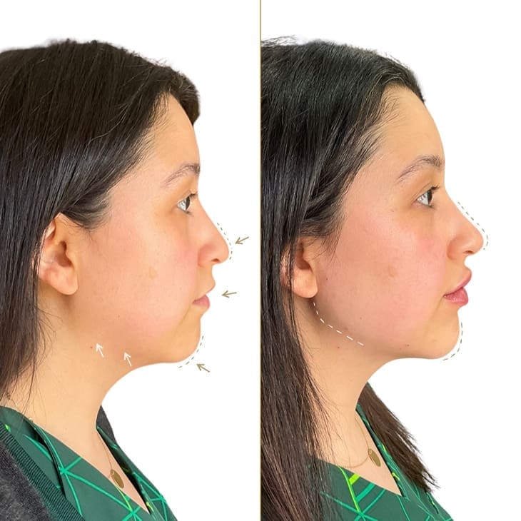 Profile Balancing Before and After - Female Patient - Dr Hass Clinic