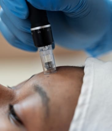 Microneedling Treatment - Dr Hass Clinic