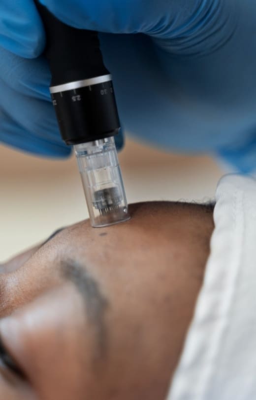 Microneedling Treatment - Dr Hass Clinic