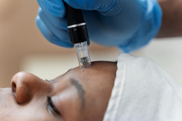 Microneedling