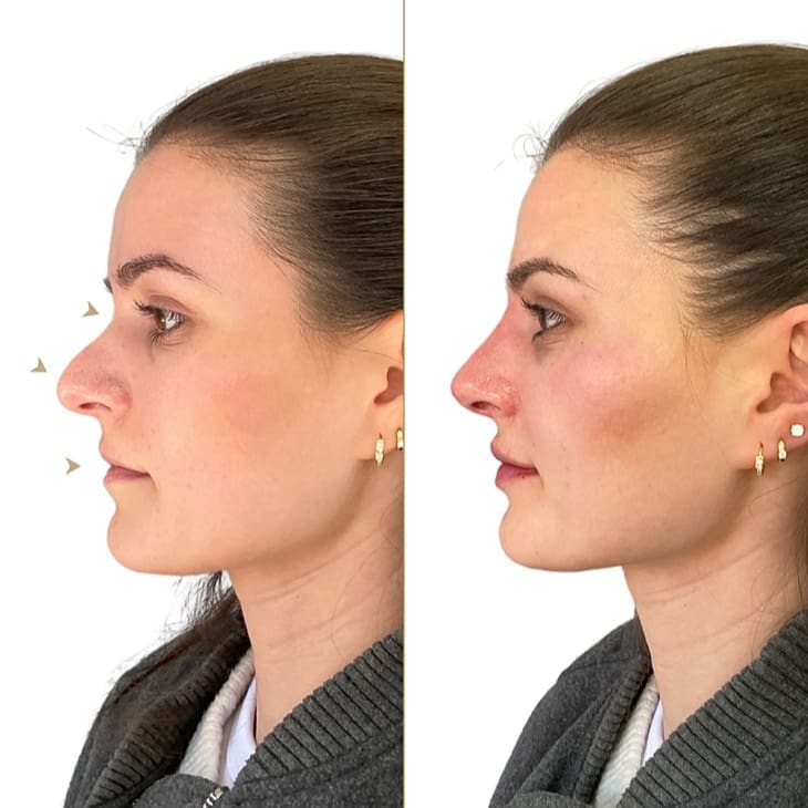 nose filler London result
