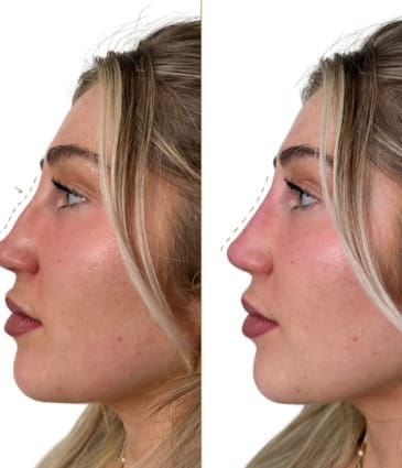 non surgical rhinoplasty London