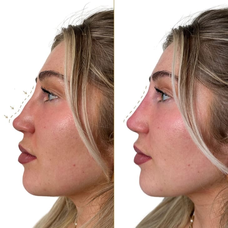 non surgical rhinoplasty London