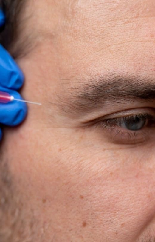Temple Filler Treatment Stage Image - Dr Hass Clinic