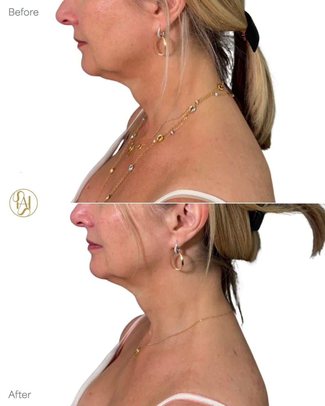 Trapezius Botox Before and After Result - Dr Hass Clinic