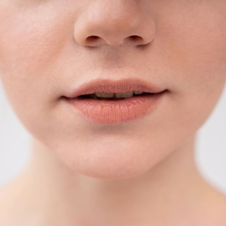 Thin Lips: Causes, Prevention and Treatment