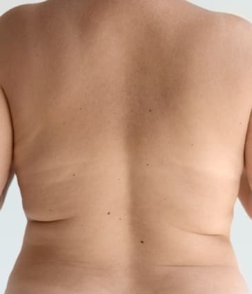 Excess Fat: Causes, Prevention and Treatments