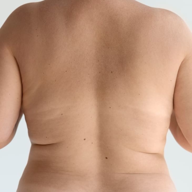 Excess Fat: Causes, Prevention and Treatments