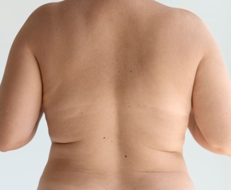 Excess Fat: Causes, Prevention and Treatments