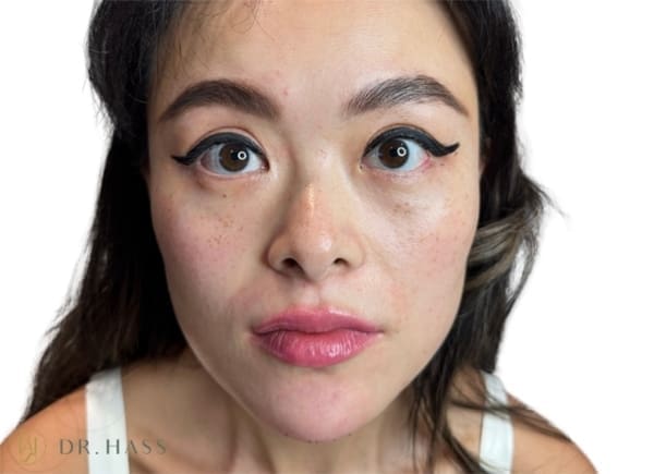 Masseter reduction