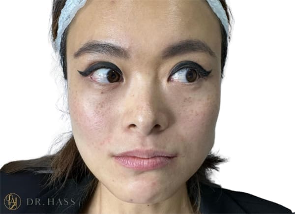 Masseter reduction