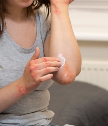 patient-suffering-from-dermatitis