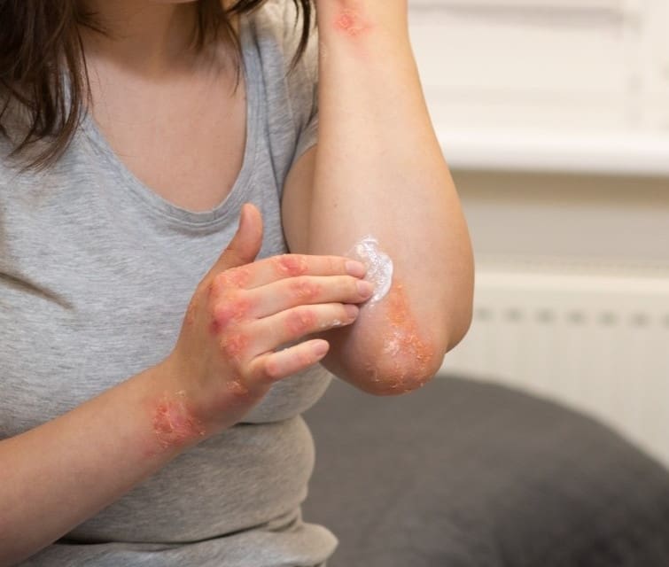 patient-suffering-from-dermatitis