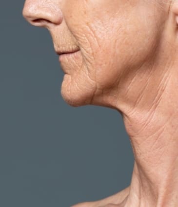 Turkey Neck: Causes, Prevention and Treatments