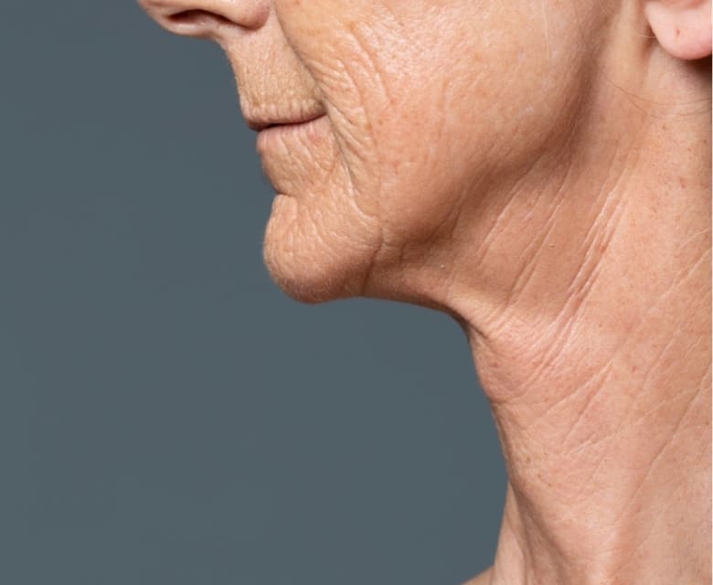 Turkey Neck: Causes, Prevention and Treatments