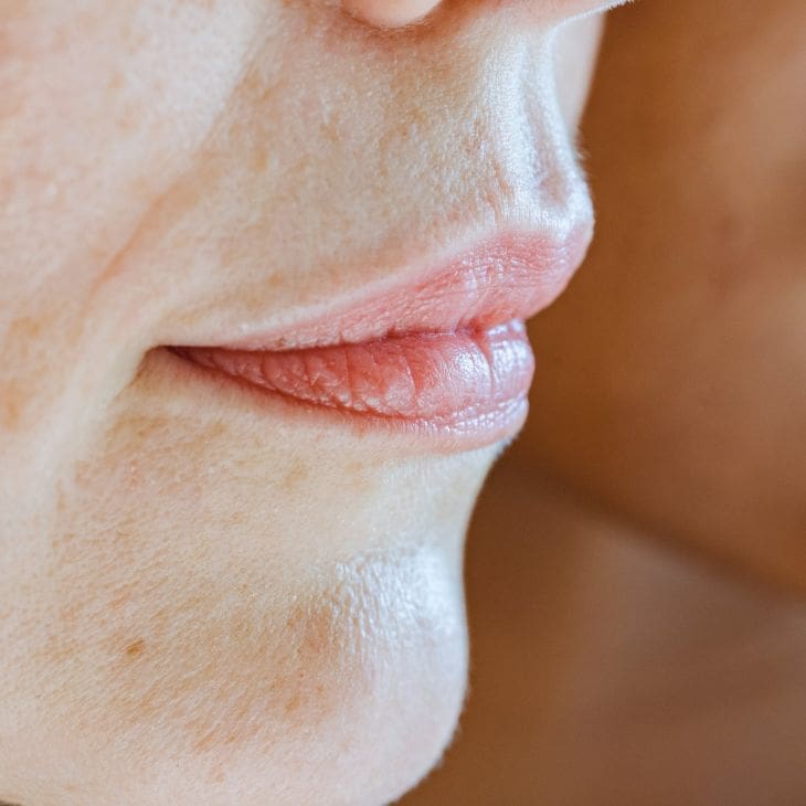 Botox® for Trapezius muscle (Barbie Botox®)